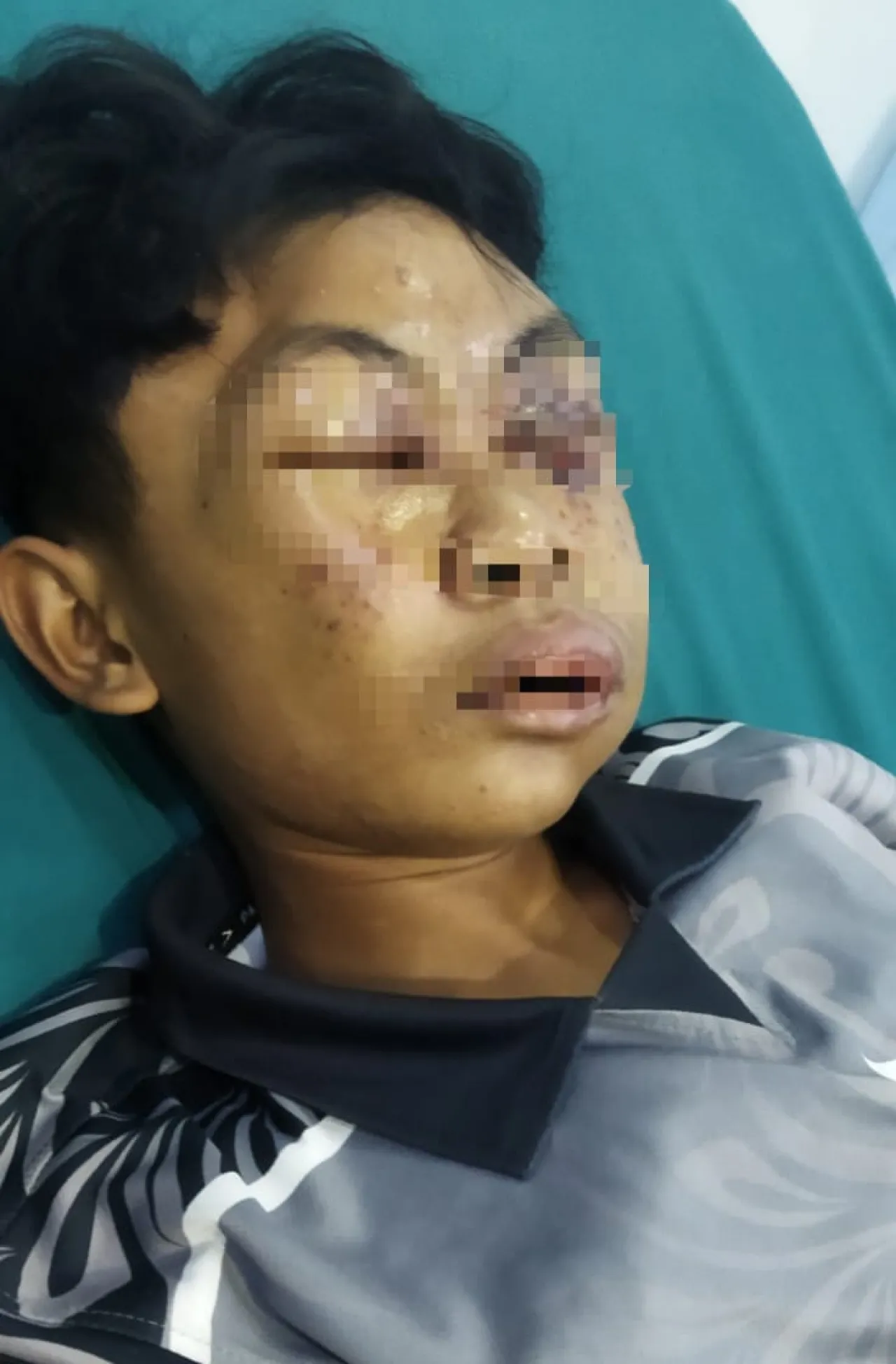 Dugaan Kekerasan, Wajah Santri Kayong Utara Lebam, Pengurus Ponpes Labbaik Indonesia Sebut Itu Cuma Alergi Obat